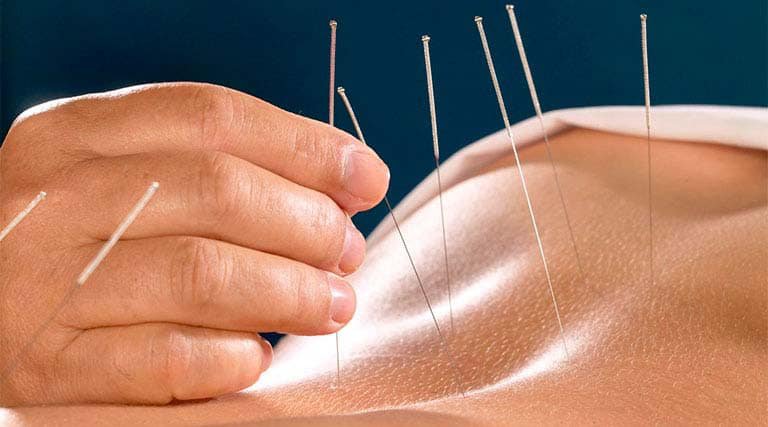 Y học cổ truyền thường &aacute;p dụng phương ph&aacute;p ch&acirc;m cứu trong điều trị bệnh