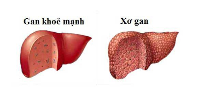 Bệnh xơ gan nguy hiểm với t&iacute;nh mạng người bệnh